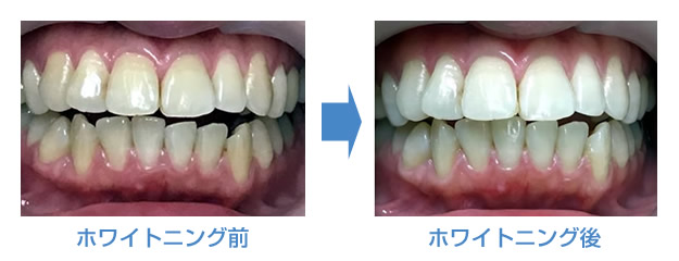 通常2回のホワイトニングを行います